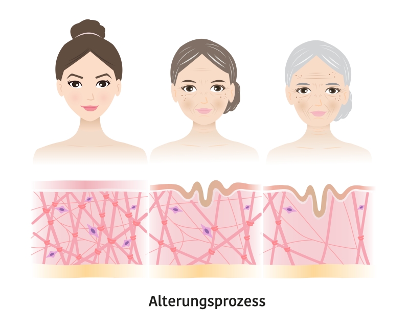 Illustration des Haut-Alterungsprozesses - Augenklinik Sulzbach illustration haut alterungsprozess augenklinik sulzbach