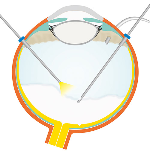 Retinal surgery