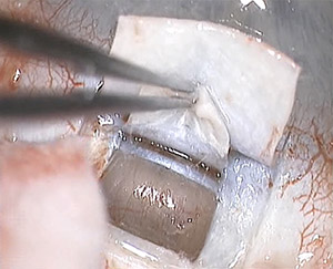 Suprachoroidale Drainage